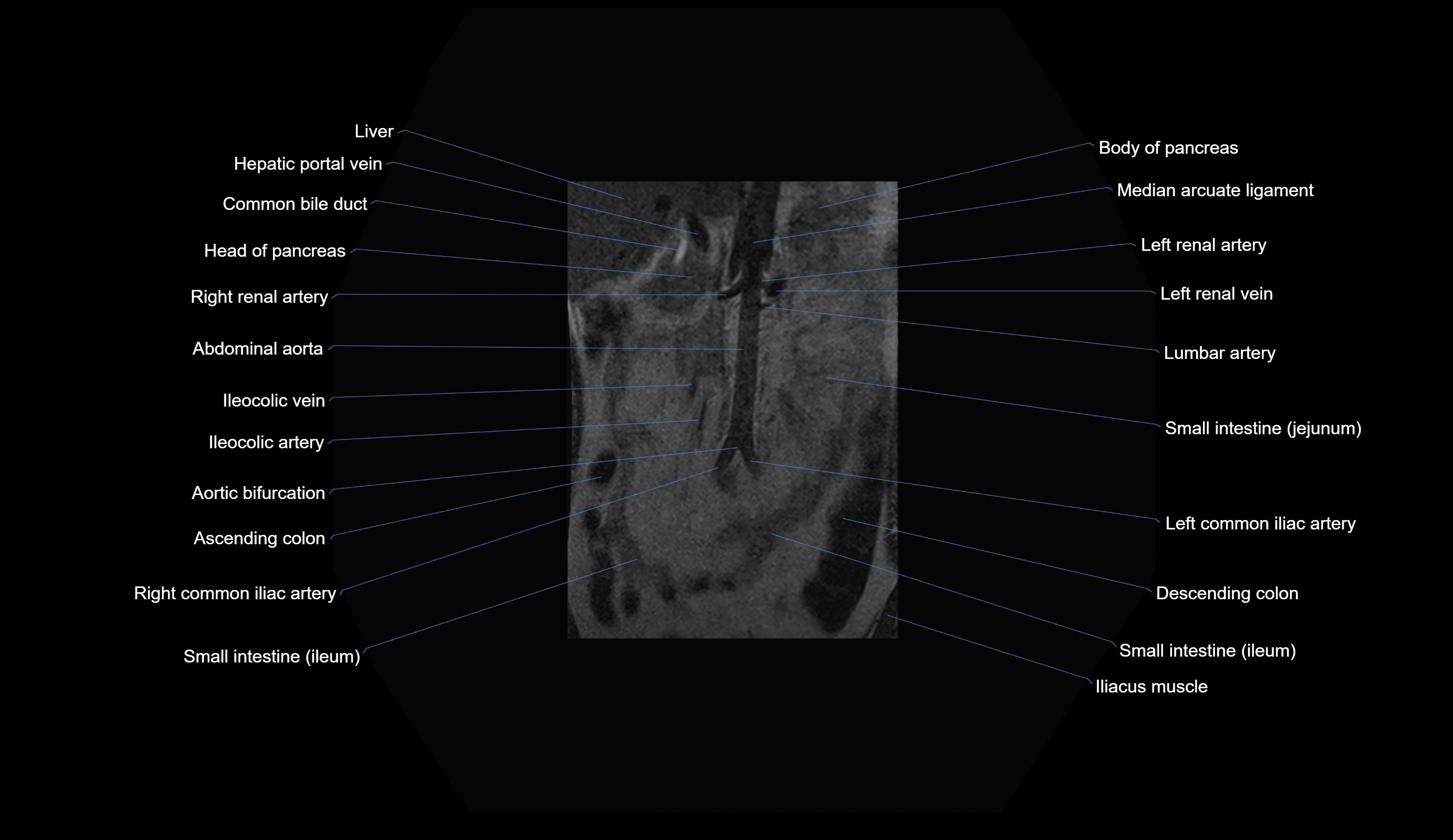 MRI lumbar spine coronal cross sectional anatomy 3T radiology  image-img-00001-00001.webp